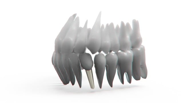 **Analiza spektralna mikroorganizmów osiadłych na implantach stomatologicznych jako metoda wczesnego wykrywania peri-implantitis**